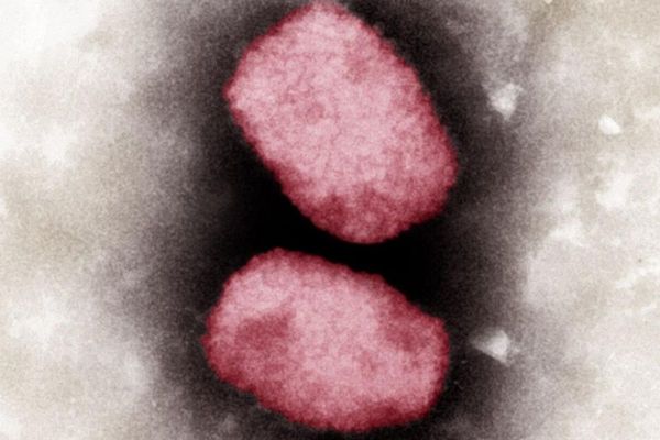 PCR tests for Monkeypox: How is the virus is detected?