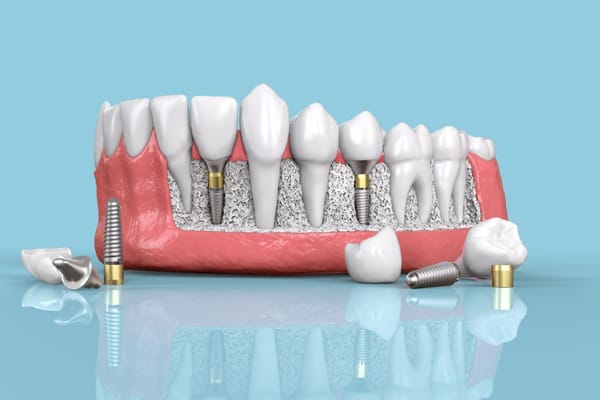 Understanding the Cost of Dental Implants in Dubai